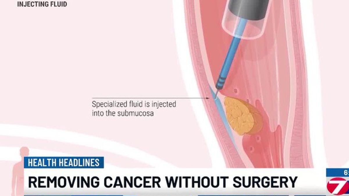 Removing cancer without surgery | Haystack News