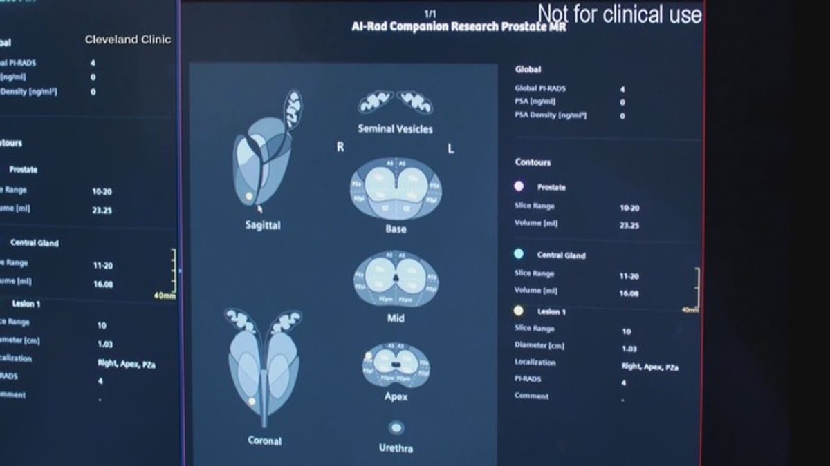 New AI tool could change how prostate cancer is detected | Haystack News