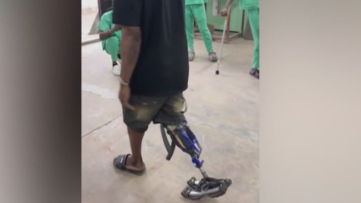 'Bike leg': Prosthetist develops artificial limbs with bicycle parts ...