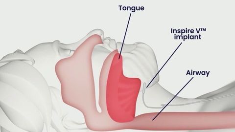 Implant Could Treat Sleep Apnea Without Cpap Haystack News