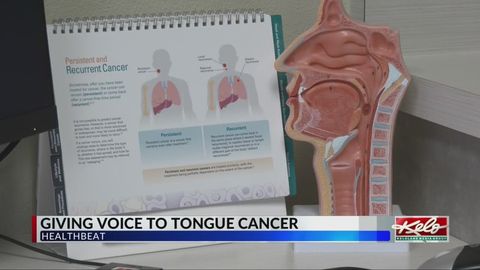 Giving a voice to tongue cancer | Haystack News